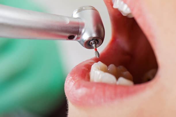 Best Emergency Tooth Extraction in Arkwright, SC